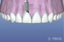 options_implant